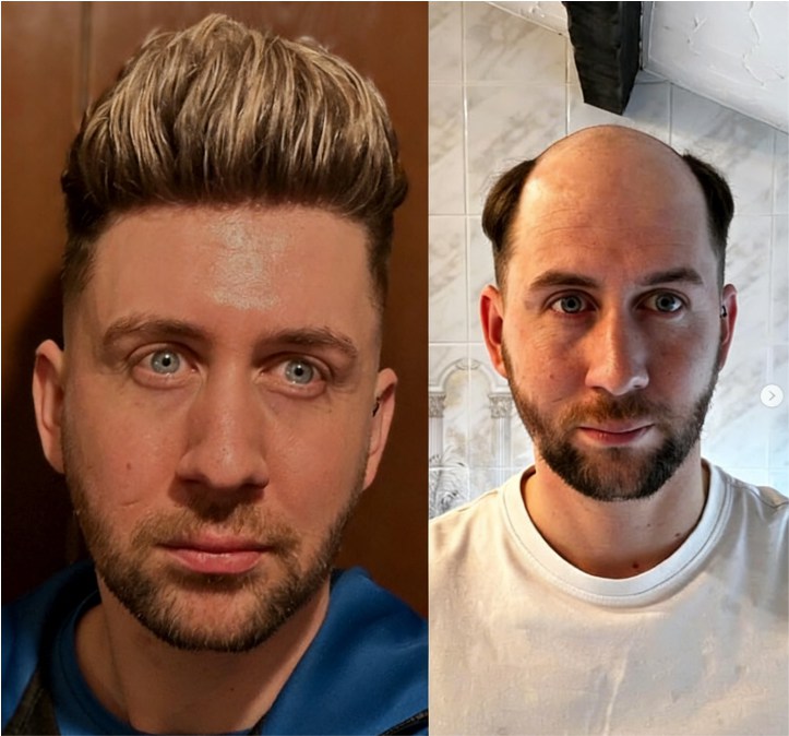 0406K | 0.04-0.06 mm Single Split Knots Vollständig Ultra - dünne Skin - Einzelsplit - Knoten - Basis | Upgraded Mirage | Männer - Toupee | Die Wahl von Promis