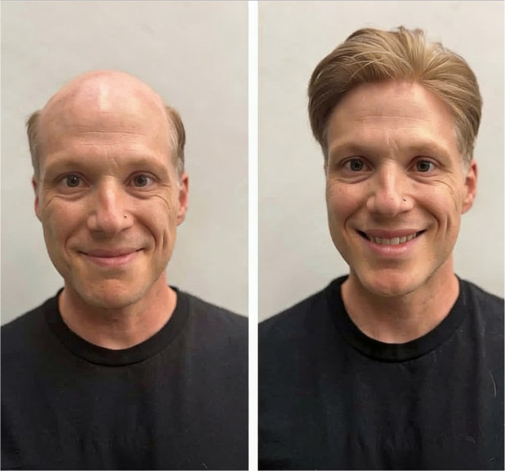 0304V| 0.03–0.04 mm V-Loop Herren-Haarsystem | Ultra-dünne Skin-Base, voll V-Loop, extrem natürlich & transparent